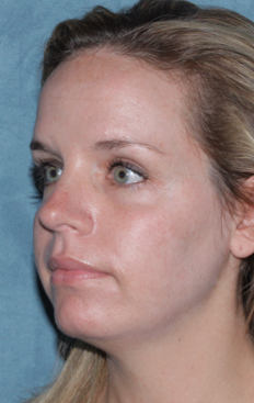 Fraxel Dual Laser Treatment after 1064719