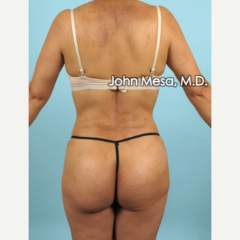 35-44 year old woman treated with Liposuction of flanks, back and sacrum after 3659820