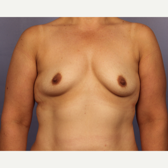 45-54 year old woman treated with Breast Augmentation before 3671527