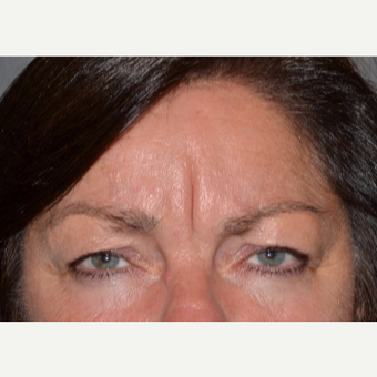55-64 year old woman treated with Botox before 3520210
