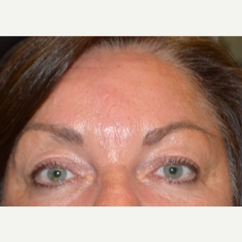 55-64 year old woman treated with Botox after 3520210