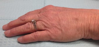 60 Year Old Female Treated for Aging Hands with IPL and Filler 804551