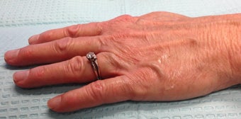 60 Year Old Female Treated for Aging Hands with IPL and Filler 804551