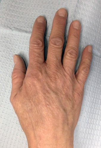 60 Year Old Female Treated for Aging Hands with IPL and Filler after 804551