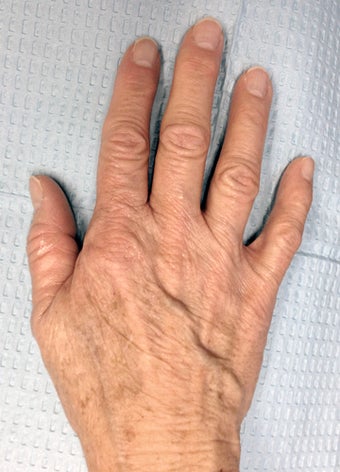 60 Year Old Female Treated for Aging Hands with IPL and Filler before 804551