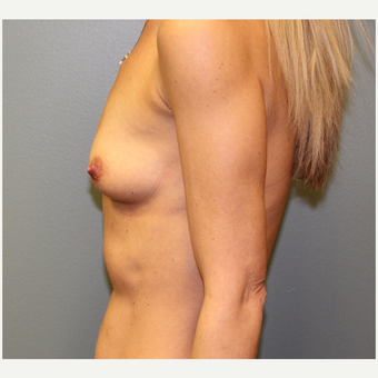35-44 year old woman treated with Breast Augmentation before 3253864