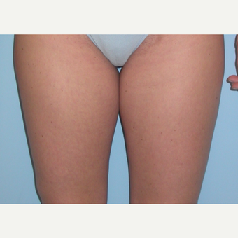 35-44 year old woman treated with Liposuction before 3076320