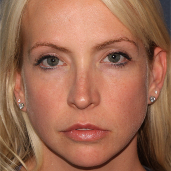 32 year old woman treated once with Botox for jaw/masseter reduction before 3617546