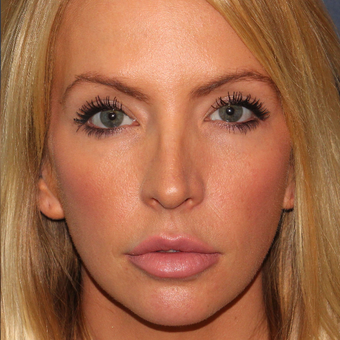 32 year old woman treated once with Botox for jaw/masseter reduction after 3617546