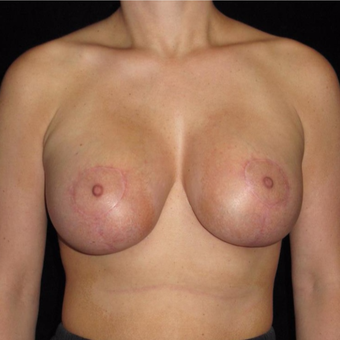 28 year old woman with asymmetry treated with Breast Augmentation after 3802639