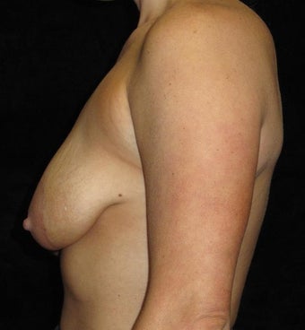 28 year old woman with asymmetry treated with Breast Augmentation 3802639