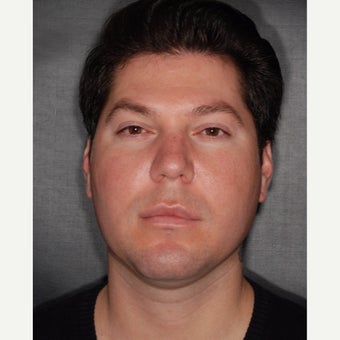 25-34 year old man treated with Buccal Fat Removal before 2251432