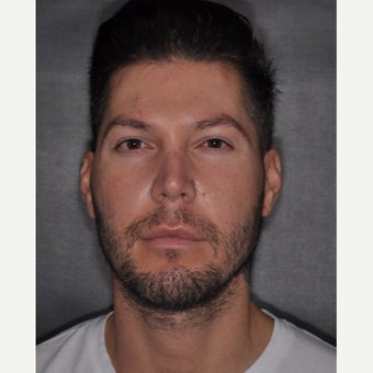 25-34 year old man treated with Buccal Fat Removal after 2251432