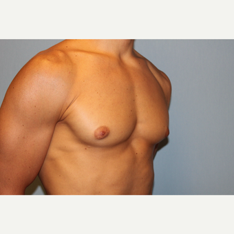 25-34 year old man treated with Male Breast Reduction before 3565072