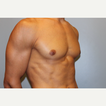 25-34 year old man treated with Male Breast Reduction after 3565072