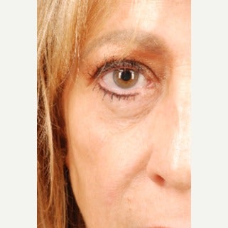 45-54 year old woman treated with Fat Transfer 1648254