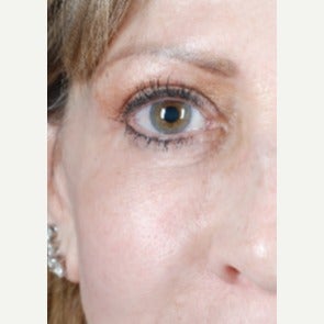 45-54 year old woman treated with Fat Transfer 1648254