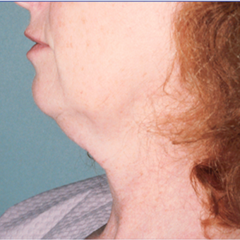 45-54 year old woman treated with Facelift before 3476080