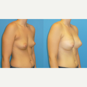 25-34 year old woman treated with Breast Augmentation after 3454770