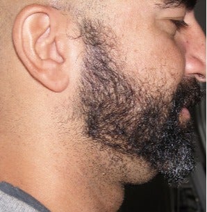 25-34 year old man treated with Lipodissolve for chin fat before 3209000