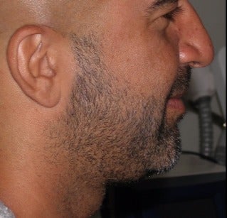 25-34 year old man treated with Lipodissolve for chin fat after 3209000