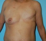 Left DIEP Flap Breast Reconstruction with Right Periareolar Breast Lift before 1074117