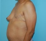 Left DIEP Flap Breast Reconstruction with Right Periareolar Breast Lift 1074117