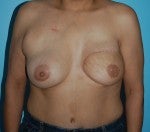 Left DIEP Flap Breast Reconstruction with Right Periareolar Breast Lift after 1074117