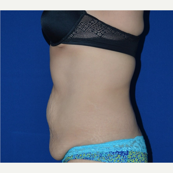45-54 year old woman treated with No-Drain Tummy Tuck before 3655768