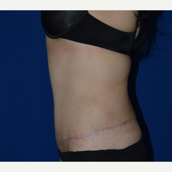 45-54 year old woman treated with No-Drain Tummy Tuck after 3655768