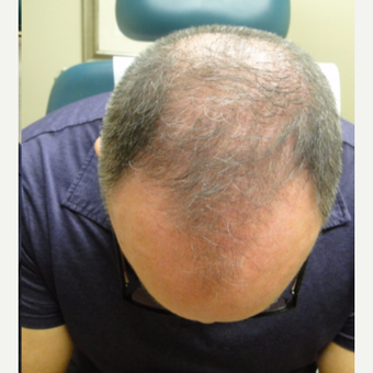51 yr old male with 4 treatments also on propecia after 3581854