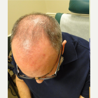 51 yr old male with 4 treatments also on propecia before 3581854