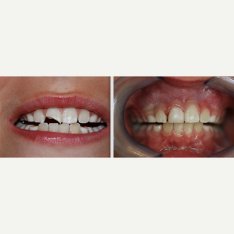 Fractured front tooth - an instant fix before 3174444