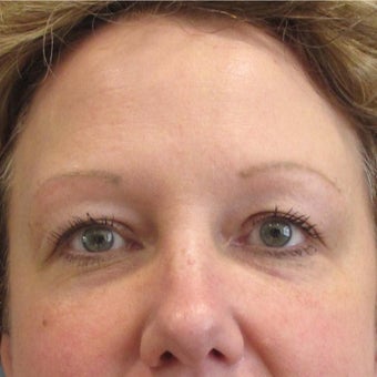45-54 year old woman treated with Restylane to the Tear Trough (lower eyelids) after 2035955