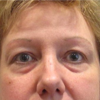45-54 year old woman treated with Restylane to the Tear Trough (lower eyelids) before 2035955