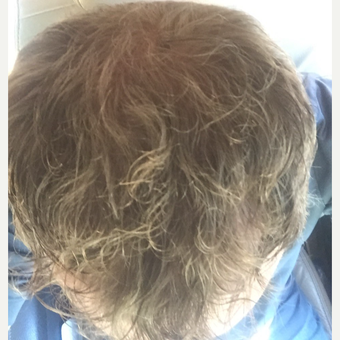 35-44 year old man treated with FUE Hair Transplant after 3062434