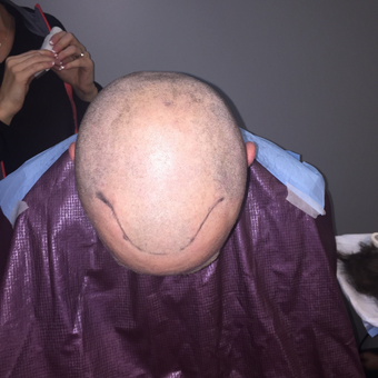 35-44 year old man treated with FUE Hair Transplant before 3062434