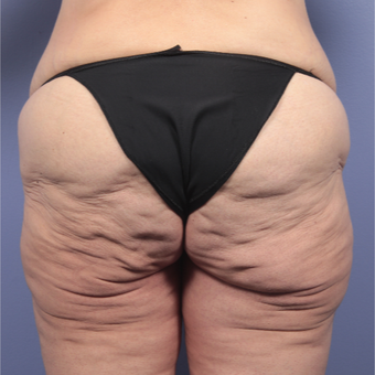 45-54 year old woman treated with Body Lift before 3666059