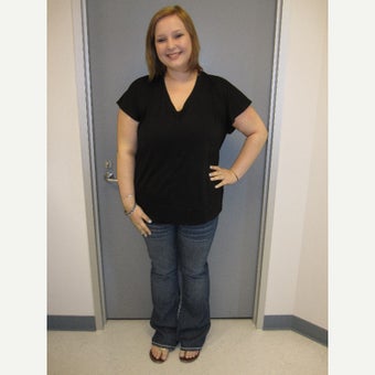 18-24 year old woman treated with Sleeve Gastrectomy after 2042558