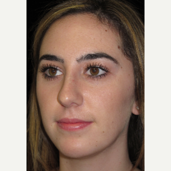 Scarless Closed Rhinoplasty after 3586234