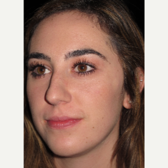 Scarless Closed Rhinoplasty before 3586234