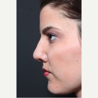 25-34 year old woman treated with Revision Rhinoplasty after 1851731