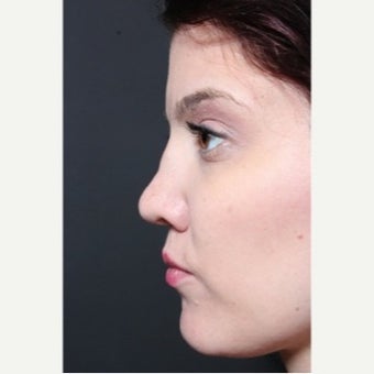 25-34 year old woman treated with Revision Rhinoplasty before 1851731