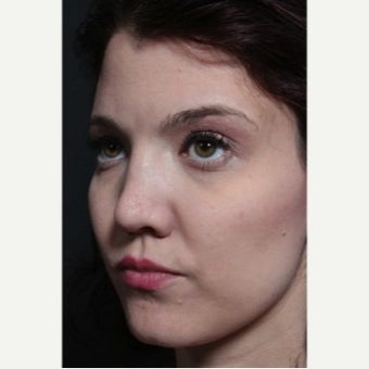 25-34 year old woman treated with Revision Rhinoplasty 1851731