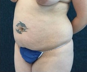 35-44 year old woman treated with Tummy Tuck before 3219157