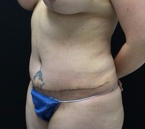 35-44 year old woman treated with Tummy Tuck after 3219157