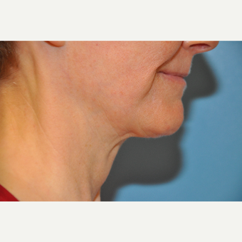 65-74 year old woman treated with ThermiTight Neck before 3075725