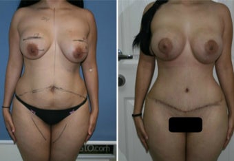 25-34 year old woman treated with Mommy Makeover before 3170105