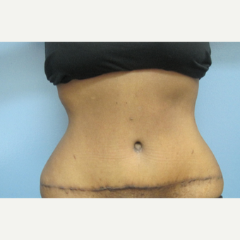 25-34 year old woman treated with Tummy Tuck after 2883216