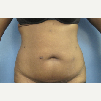 25-34 year old woman treated with Tummy Tuck before 2883216